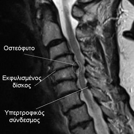 Μέσα όπως η ξηρά βελόνη (Kietrys et al. 2013)(Liu et al. 2014) και το 830-nm laser (Damgaard et al. 2013)(Furlan et al. 2012) επιδρούν θετικά στον αυχενικό πόνο.