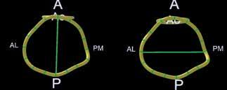 Ao: αορτή, A: anterior, πρόσθιο, P: posterior, οπιίσθιο, AL: anterolateral, προσθιοπλάγιο, PM: posteromedial, εσω-οπίσθιο τμήμα του μιτροειδικού δακτυλίου τους μάρτυρες δεν είχε πάχυνση των γλωχίνων.