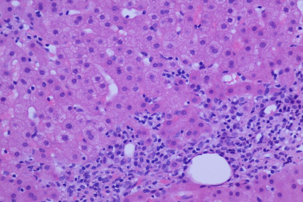 Clinical case 14: No association of biochemical with histologic activity; a portal area with remarkable