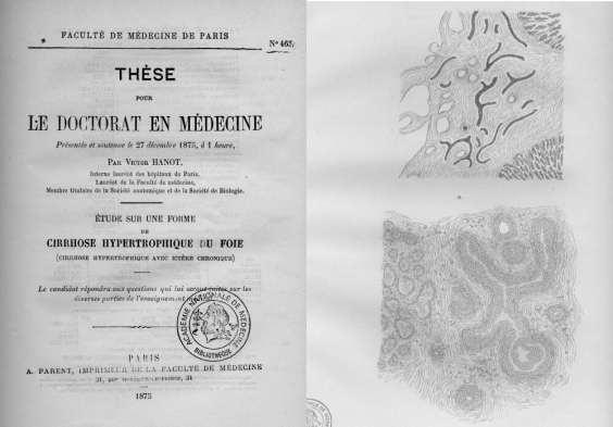 Πρωτοπαθής χολική χολαγγειίτιδα Thomas Addison & William Gull (1851) 1 η πληρέστερη περιγραφή 1875 &1892 1930-1950: Χρονία ενδοηπατκή καταστροφική