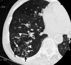 1 η Νοσηλεία Απεικονιστικός έλεγχος CT Άνω - κάτω κοιλίας (-) Εcho καρδιάς(-) CT Θώρακος εικόνα tree in bud Διαφορικη διάγνωση Λοιμώδη μυκοβακτηρίδια,ιοι,μύκητες,pneumonocystis Κακοήθεια λέμφωμα,