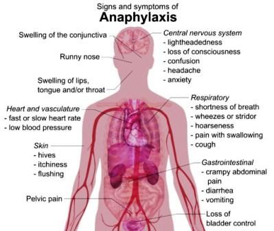 Anafülaksia on raske eluohtlik allergiline reaktsioon mitme organsüsteemi poolt Nahk ja