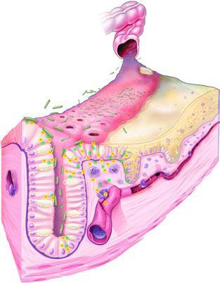 Pathogenesis of CDI 1. CDI spores survive in the environment for long periods of time.