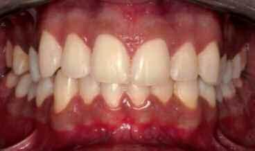 Η απόχρωση λαµβάνεται κυρίως από την οδοντίνη κι εµφανίζει 4 διαβαθµίσεις: Α (κόκκινο-καφέ), Β (πορτοκαλί κίτρινο), Γ (πράσινο-γκρίζο) και (ροζγκρίζο).