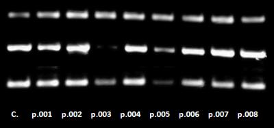 8 ασθενείς 1 υγιής RT-PCR ανάλυση Α Δείγµα DNA/RNA αποµόνωση Ανάλυση της γονιδιακής έκφρασης σε δείγµατα ασθενών µε διαταραχές της αιµοποίησης Ο p.003 διακρίνεται κλινικά από τους p004, p. 007 και p.