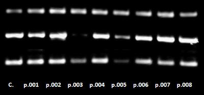 8 ασθενείς 1 υγιής RT-PCR ανάλυση Α Δείγµα DNA/RNA αποµόνωση Ανάλυση της γονιδιακής έκφρασης σε δείγµατα ασθενών µε διαταραχές της αιµοποίησης Ο p.003 διακρίνεται κλινικά από τους p004, p. 007 και p.