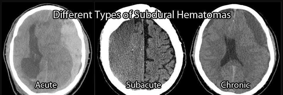 2. Υποξύ υποσκληρίδιο αιμάτωμα Τα συμπτώματα του οποίου είναι δυνατόν να εμφανιστούν από 48 ώρες έως περίπου 3 εβδομάδες μετά τον τραυματισμό.
