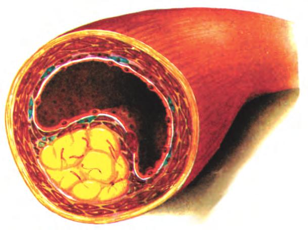 Κεφάλαιο 3 Η αρτηριοσκλήρυνση οφείλεται στη συσσώρευση λιπιδίων, ιδίως χοληστερόλης, κάτω από το εσωτερικό τοίχωμα των αρτηριών.