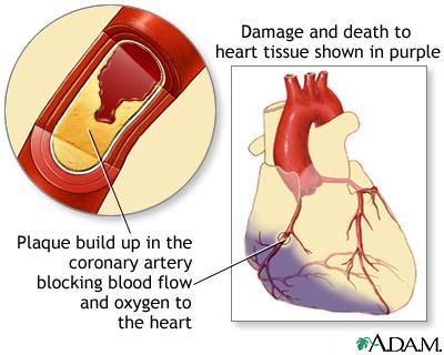 Blokada desne srčane arterije