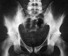 αξονική σπονδυλαρθρίτιδα η διάγνωση στηρίζεται στο συνδυασμό κλινικής (οσφυαλγία) και απεικονιστικής ιερολαγονίτιδας (MRI ή ακτινολογικά)