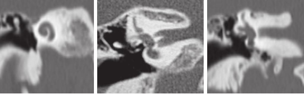 Πόρος τυµπανικής µοίρας του προσωπικού νεύρου (λευκό κενό βέλος). Ακρωτήριο (µαύρος αστερίσκος). Πρώτη έλικα κοχλία E (λευκή κεφαλή βέλους). Άκανθα (µικρό λευκό βέλος).