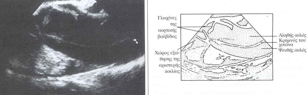 Διαχωρισμός Αορτής οφείλεται σε λύση της συνέχειας του