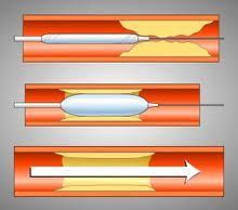 Αγειοπλαστική στεφανιαίων αρτηριών (PCI: Percutaneous coronary intervention) Stents: Εκπτυσσόμενοι μεταλλικοί νάρθηκες που κρατούν το αγγείο