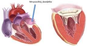 Εισαγωγή Η μιτροειδική βαλβίδα αποτελεί μια σύνθετη ανατομικά δομή και η ανεπάρκεια της συνιστά τη συνηθέστερη βαλβιδοπάθεια.