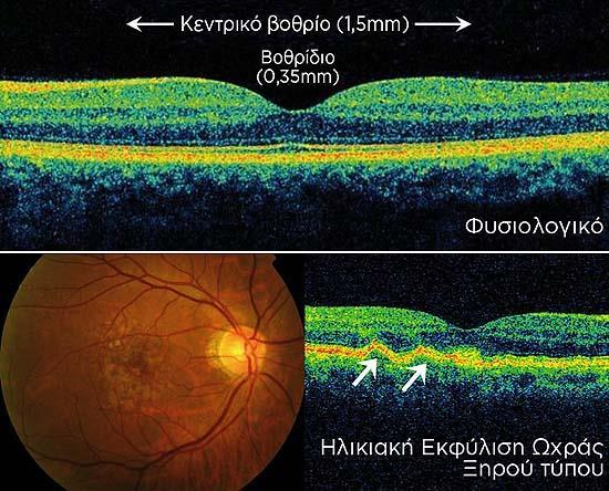 Εικόνα4(α): Υγρή εκφύλιση ωχράς κηλίδας. Εικόνα 4(β): Πάνω: OCT φυσιολογικής ωχράς.