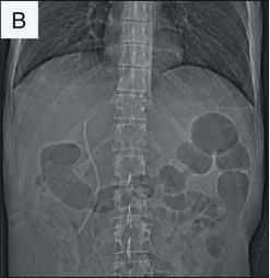 ERCP : ANΤΙΜΕΤΩΠΙΣΗ ΔΙΑΤΡΗΣΗΣ (I) Κυρίως χειρουργική παρέμβαση. ( Algorithm for the management of ERCP-related perforations.