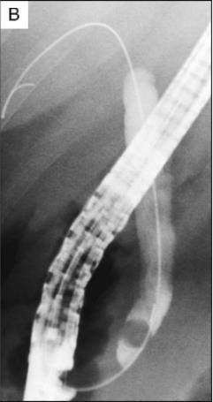 ERCP : AΛΛΑ ΣΥΜΒΑΜΑΤΑ Πνευμοθώρακας, ειλεός,