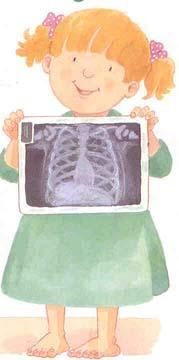 ΝΤΜ και παιδιά. 5 παιδιά ηλικίας 1-2.5 ετών χωρίς υποκείμενη νόσο του αναπνευστικού χωρίς γενετικές ανωμαλίες Βρέθηκαν να νοσούν: 4 από M.