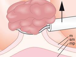 Endoscopy