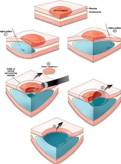 EMR Endoscopic Mucosal Resection Lift and Snare Polypectomy Submucosal Injection Polypectomy Lift/inject and cut mucosal resection Eπίπεδο