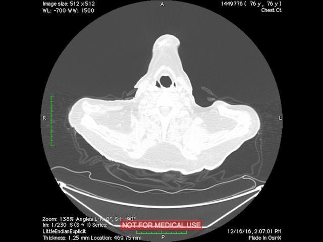 Combined Pulmonary Fibrosis and