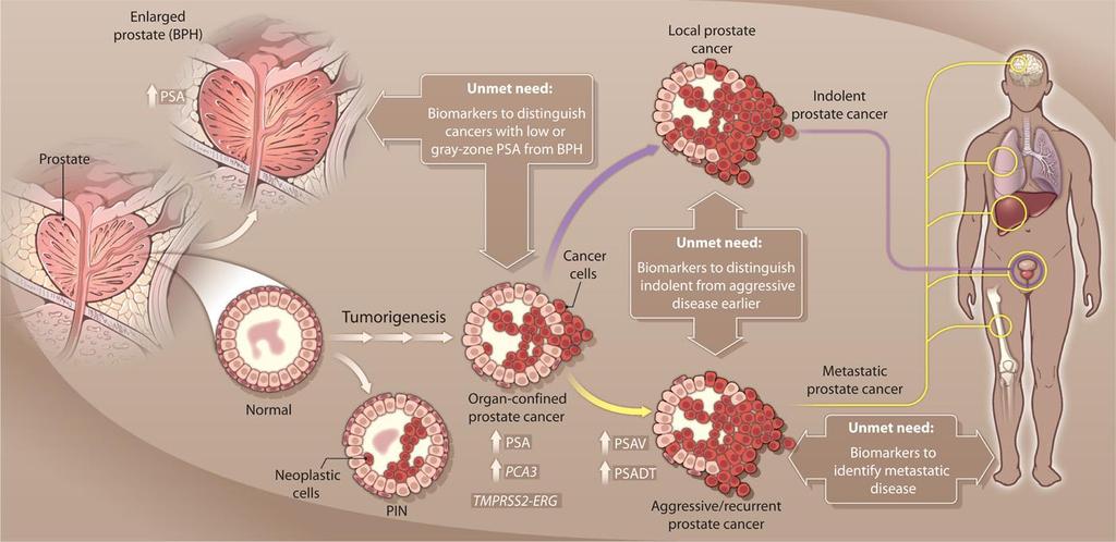 Καρκινικοί βιοδείκτες στον καρκίνο του προστάτη