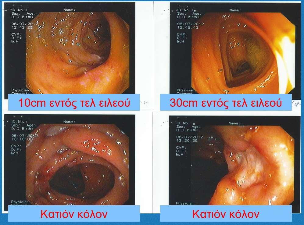 Γαστροσκόπηση Ενδοσκοπική εικόνα γαστρίτιδας Μικρές άφθες στην καρδία του στομάχου.