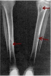 Renal Bone Disease spectrum <150 pg/ml 150-300 pg/ml >300 pg/ml Osteomalacia - defective