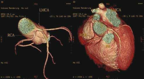 LMCA had a malignant course between the Pulmonary artery (PA) and the Aorta