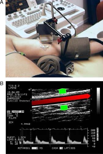 για παιδιά ή ορίζονται ως 50 mmhg πάνω από τη συστολική πίεση του εξεταζόμενου.