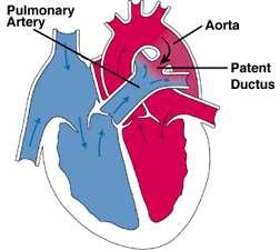 Ανοιχτός Αρτηριακός Πόρος Patent Ductus Arteriosus (PDA) Φυσιολογικά ο αρτηριακός πόρος συγκλείνει λίγο μετά την γέννηση.