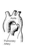 Ισθμική στένωση αορτής Coarctation of the Aorta Είναι μια ακόμη συχνή καρδιοπάθεια με συχνότητα 8-10% επί του συνόλου των συγγενών καρδιοπαθειών.