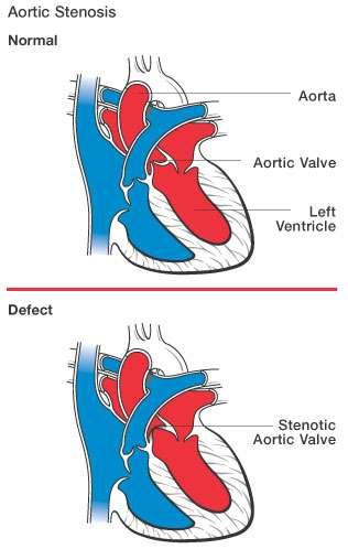 Στένωση Αορτικής Βαλβίδας Η αορτική στένωση διακρίνεται σε: Aortic Stenosis (AS) Υπερβαλβιδική (εξαιτίας μιας μεμβράνης πάνω από τους κόλπους του Valsava, εντοπισμένης στένωσης της ανιούσας αορτής ή