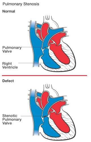 Στένωση Πνευμονικής Βαλβίδας Pulmonary Stenosis (PS) Μια ακόμη συχνή συγγενής καρδιοπάθεια με συχνότητα 8-10% επί του συνόλου των ΣΚ.