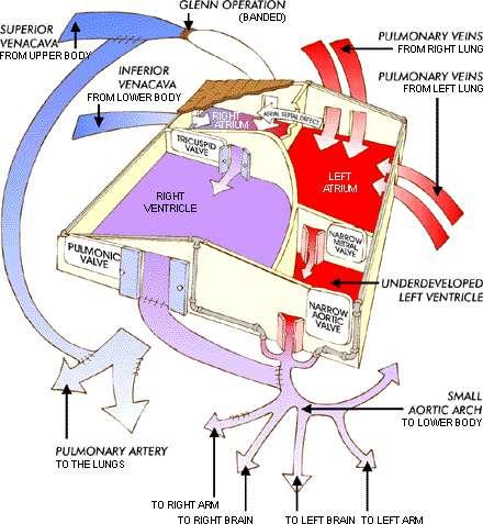 Second-Stage Operation: Glenn Operation Σε δεύτερο στάδιο, στην ηλικία των 4 με 6 μηνών, εάν η δεξιά κοιλία παραμείνει πολύ