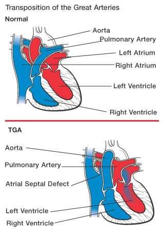 Μετάθεση των μεγάλων αγγείων Transposition of the Great Vessels (TGA) Στη συγγενή αυτή κυανωτική μορφή καρδιοπάθειας αντιστρέφεται η θέση των μεγάλων αγγείων της καρδιάς.