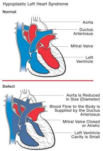 Σύνδρομο υποπλαστικής αριστερής καρδιάς Hypoplastic Left Heart Syndrome (HLHS) Στην περίπτωση του προαναφερόμενου συνδρόμου παρατηρείται υποπλασία όλης της αριστερής καρδιάς.