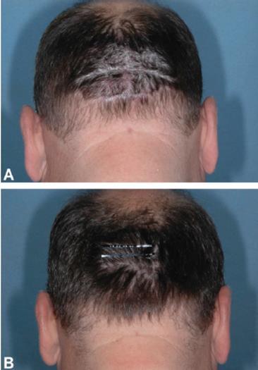 Apremilast, an oral phosphodiesterase 4 inhibitor, in patients with difficult-to-treat nail and scalp psoriasis: results of 2 phase III randomized,