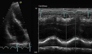 ΗΧΟΚΑΡΔΙΟΓΡΑΦIA ΣΤΗΝ ΚΑΡΔΙΑΚΗ