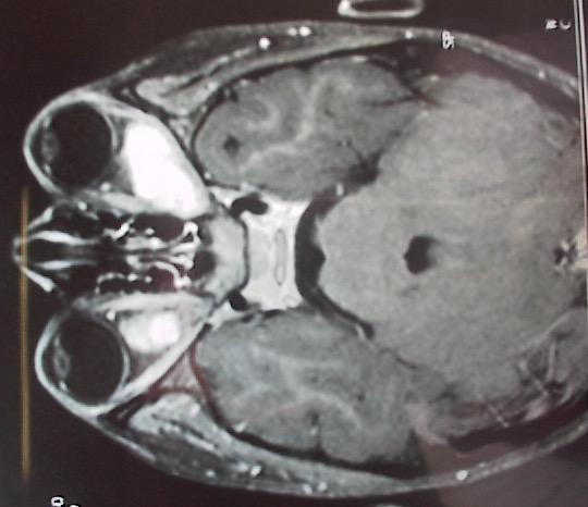 Χαμηλού βαθμού κακοήθειας γλοιώματα (Low grade gliomas) Πιλοκυτταρικό αστροκύττωμα Xειρουργική εξαίρεση Ακτινοβολία