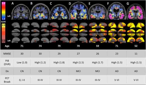 Tau positron emission tomographic imaging in aging and early Alzheimer disease Annals of Neurology Volume 79, Issue 1,