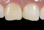 Αποκατάσταση νεογιλών δοντιών Ανασύσταση κολοβωμάτων κάτω από στεφάνες Ένθετα σύνθετης ρητίνης Υλικό αποκατάστασης όμοιο με το δόντι για αξιόπιστες αποκαταστάσεις Πολύ υψηλό ποσοστό ενισχυτικών