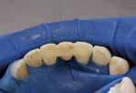 του απόντος δοντιού με τεχνητό δόντι Για προσωρινή ή ήμι-μόνιμη αποκατάσταση κενού απόντος δοντιού χρησιμοποιώντας φυσικό δόντι που έχει εξαχθεί Για