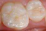 περίπτωση με τον φωτο-πολυμερισμό Δεν χρειάζεται προετοιμασία του σκληρού οδοντικού ιστού Κατάλληλο και για μεγάλες κοιλότητες Άμεσα συμπυκνώσιμο μετά την τοποθέτηση στην κοιλότητα Δεν κολλάει στο