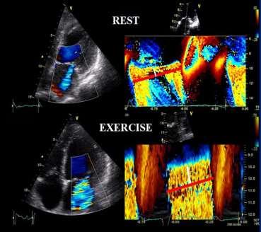 The Dynamic Nature of Secondary MR Underlying LV systolic dysfunction Transient increase in MR May cause acute