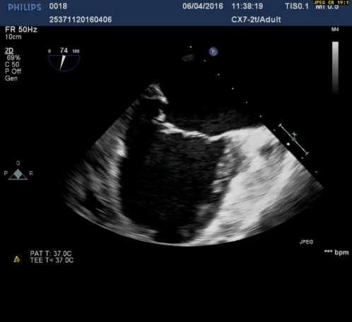 ISCHEMIC