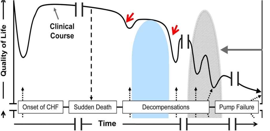 The Timing of Drugs, Device and Interventions in Heart Failure A CE-I/ARNI BB MRA ICD/CRT Acute HF