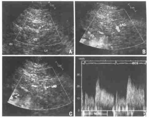 92 2003 2 31 2 Chin J Cardiol February 2003 Vol1 31 No12 (intracoronary Doppler ICD) CFVR 46 ( ) 23 23 [ ( PTCA) 19 PTCA 4 ] 34 12 3277 (58 10) [ > 200mm Hg (1 mm Hg = 01133kPa) > 110mm Hg] ( < 90mm