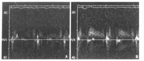 2003 2 31 2 Chin J Cardiol February 2003 Vol1 31 No12 93 (89 %) ; 1 (2 %) 6 (13 %) 39 (85 %) ;1 LAD TTDE LAD 98 % 2 A B 100g kg - 1 min - 1 99 % 8m 50g kg - 1 min - 1 2m LAD Bartel [2 ] 20 LAD 140g