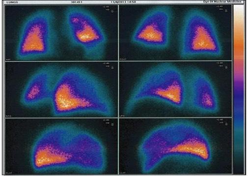 V/Q scan